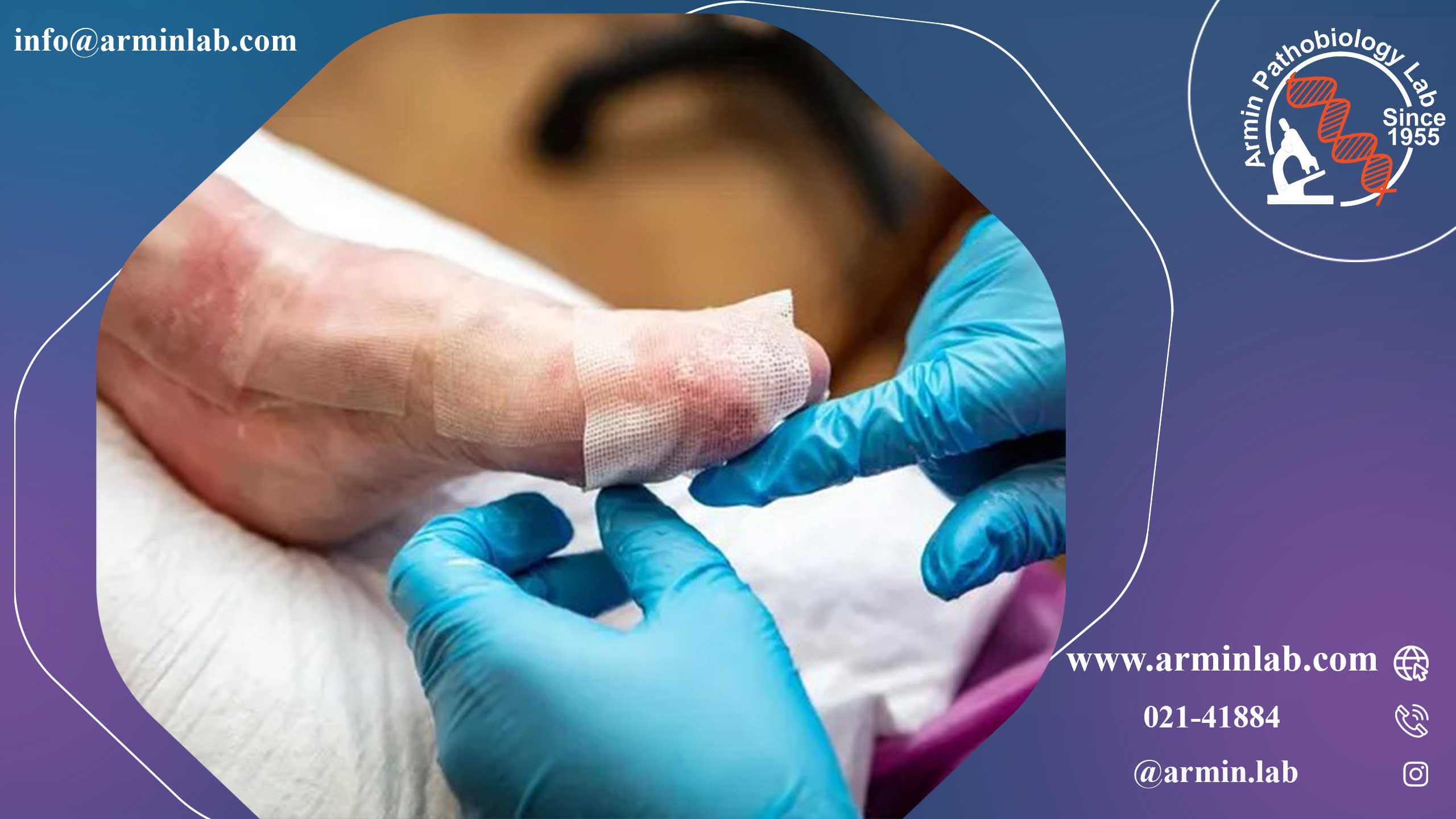 بیماری پروانه‌ای(Epidermolysis bullosa)