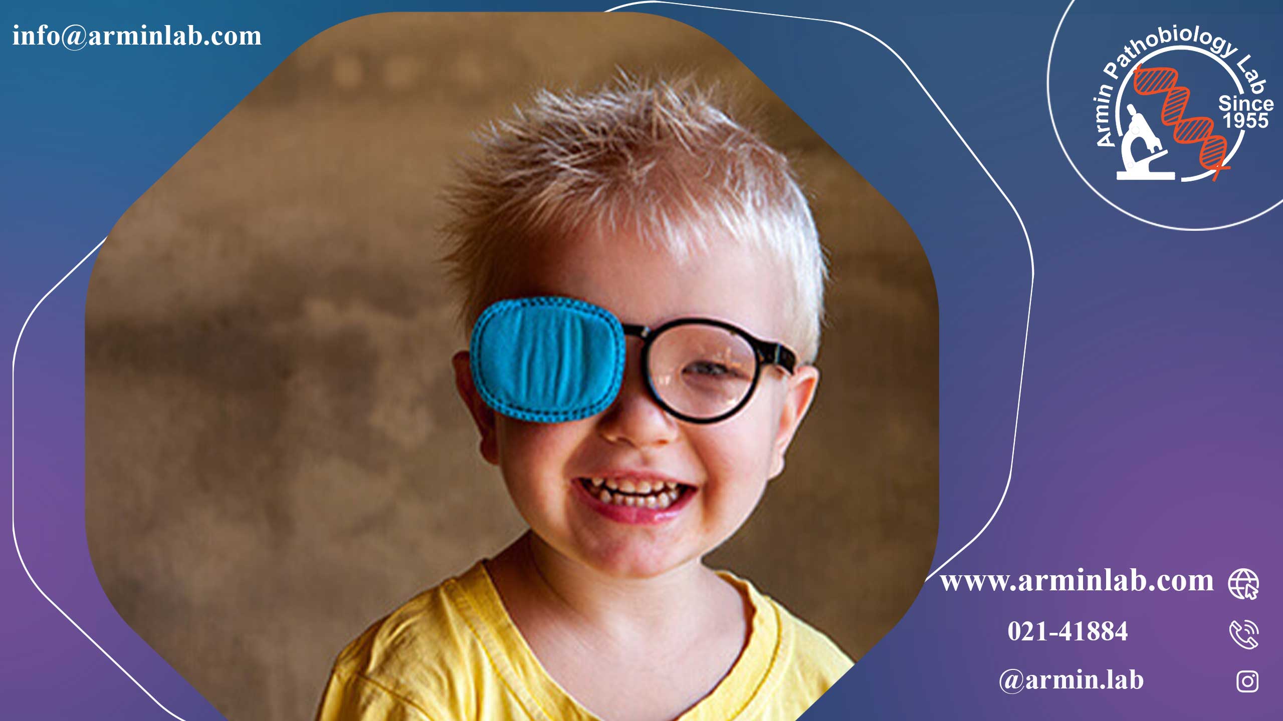 تنبلی چشم (آمبلیوپی)