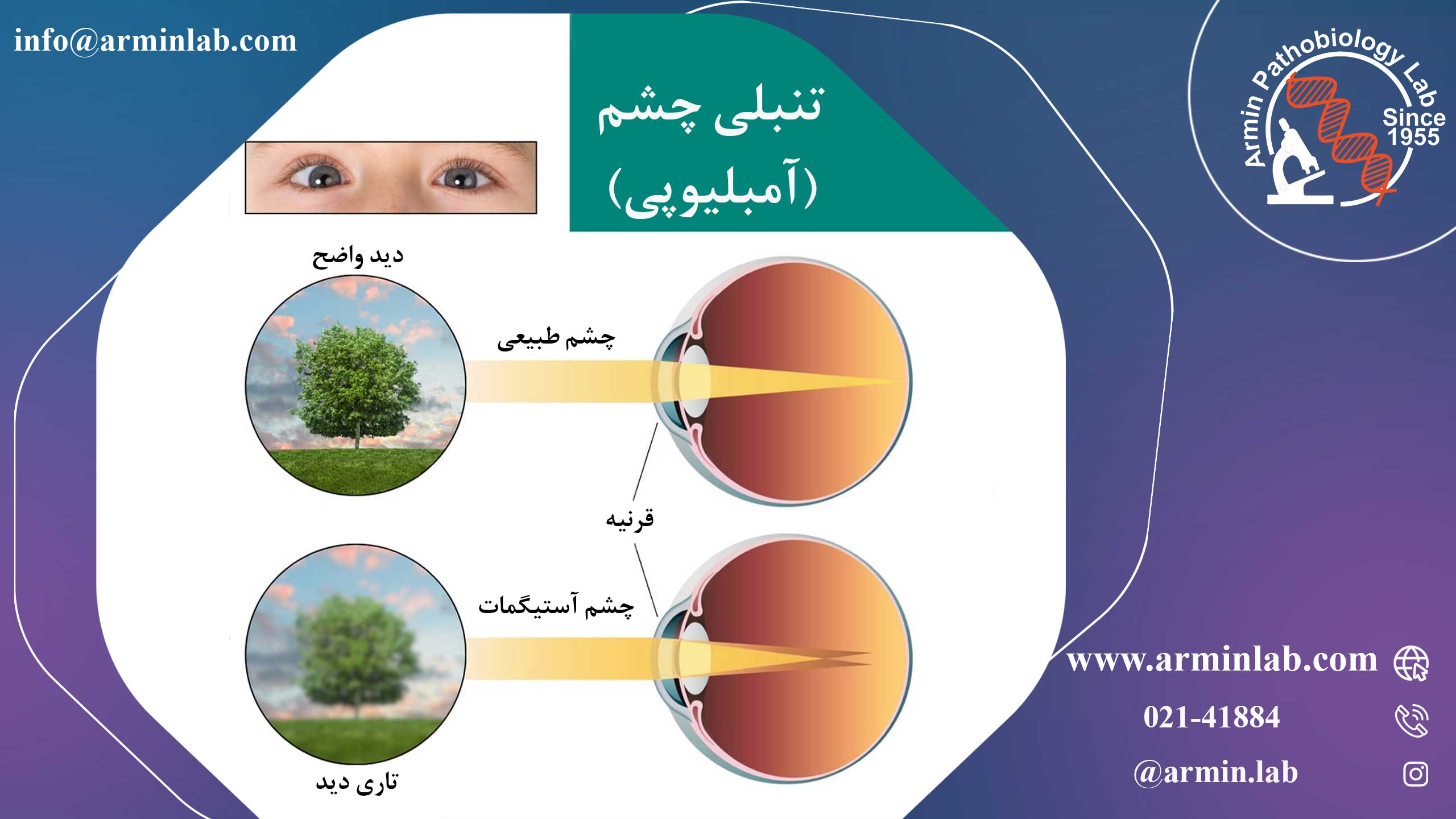 تنبلی چشم (آمبلیوپی)