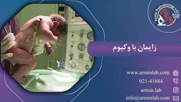 زایمان با وکیوم