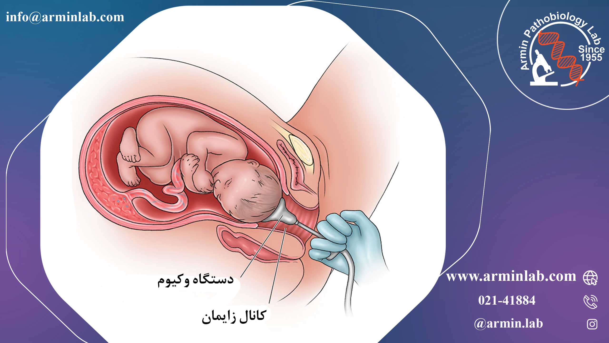 زایمان با وکیوم