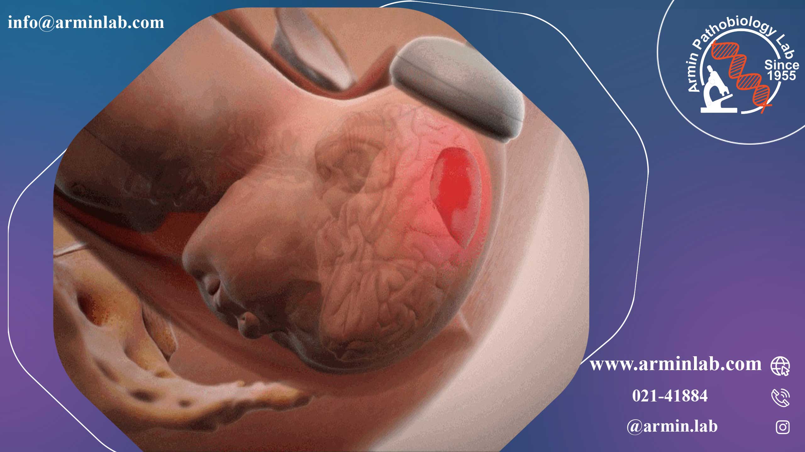 زایمان با وکیوم