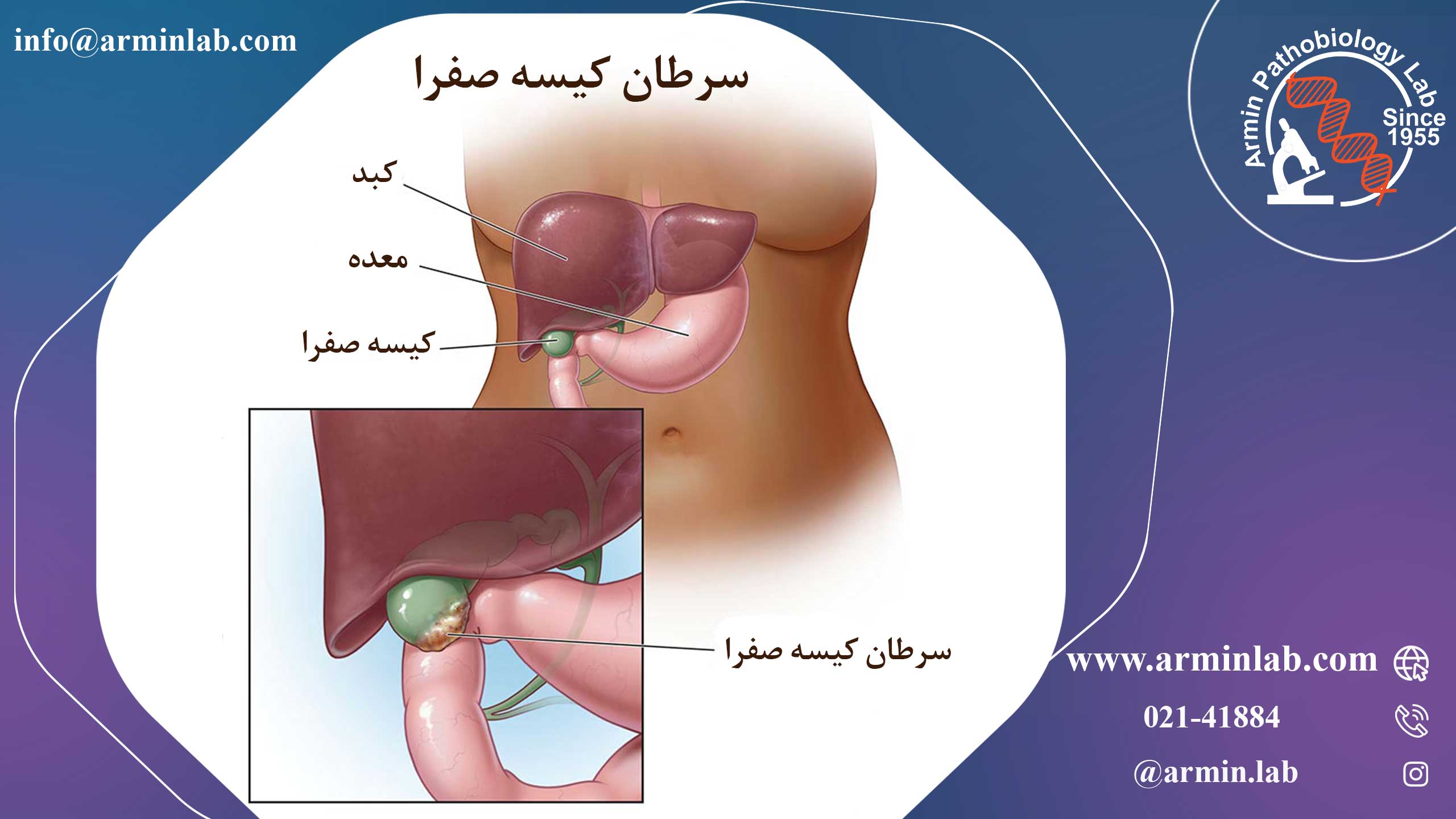 سرطان کیسه صفرا