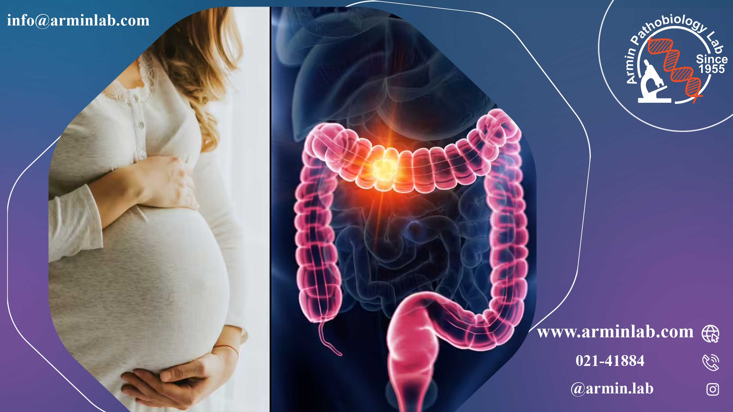 سندرم روده تحریک‌پذیر در دوران بارداری
