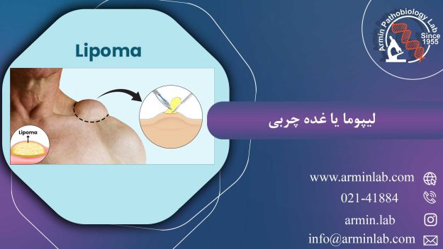 لیپوما یا غده چربی