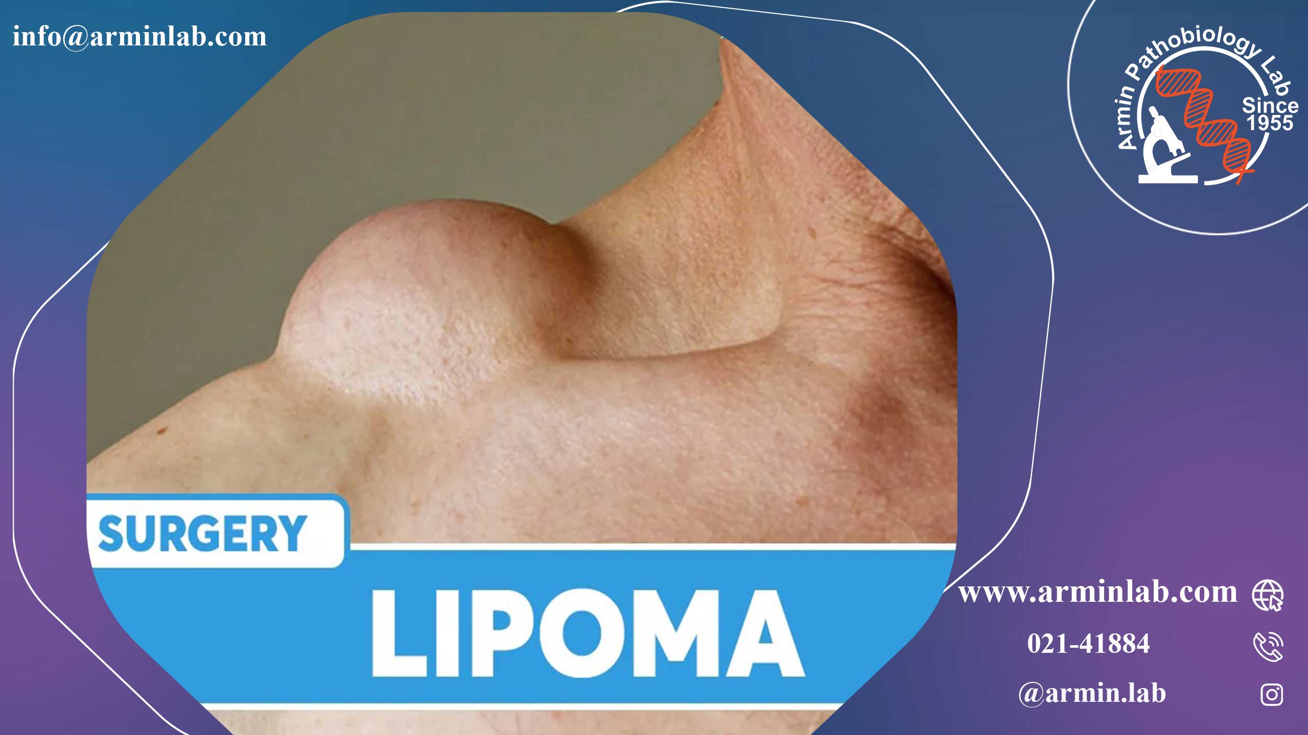 لیپوما یا غده چربی