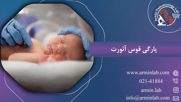 پارگی قوس آئورت