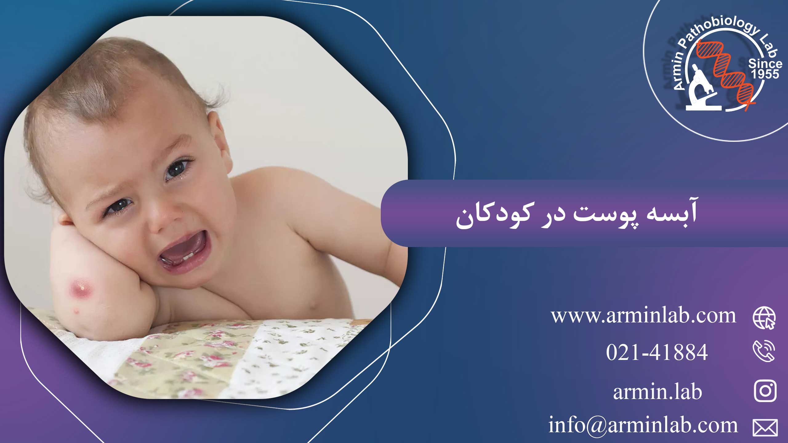 آبسه‌ پوست در کودکان