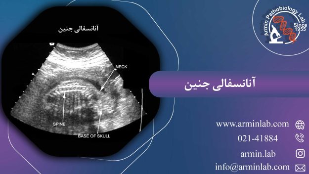 آنانسفالی جنین