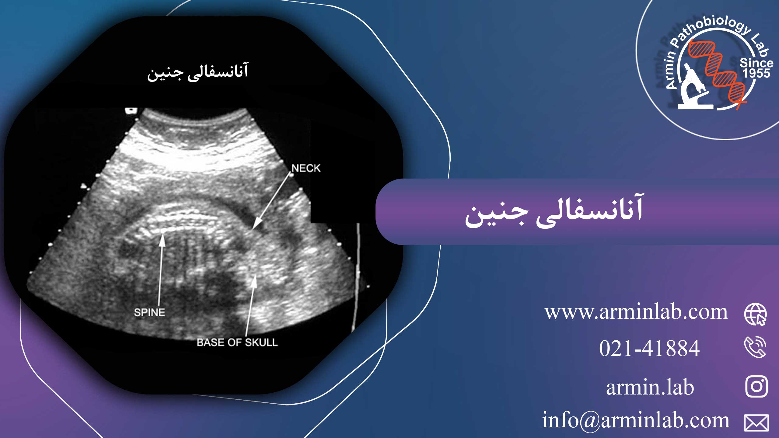 آنانسفالی جنین