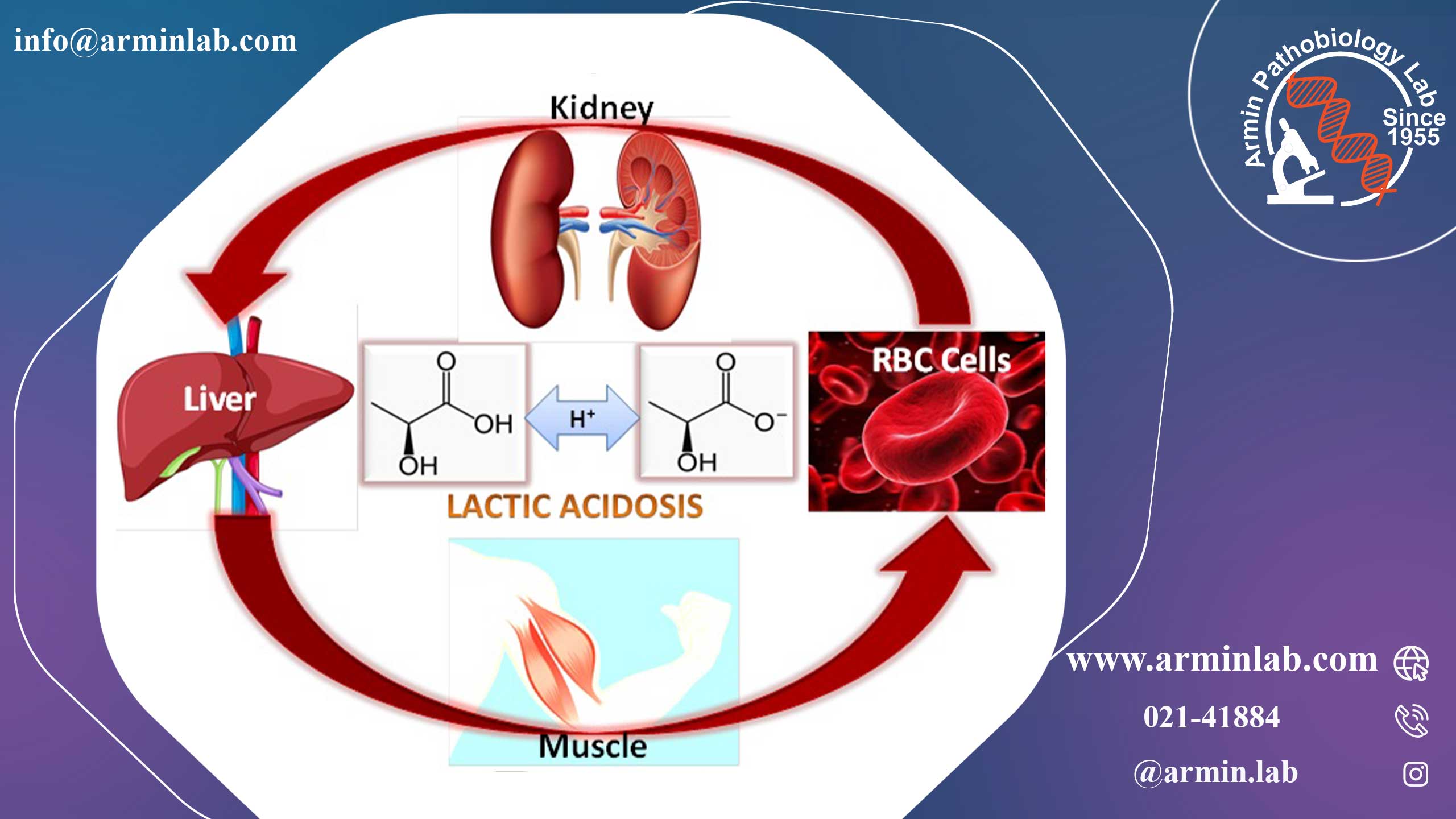 اسیدوز لاکتیک