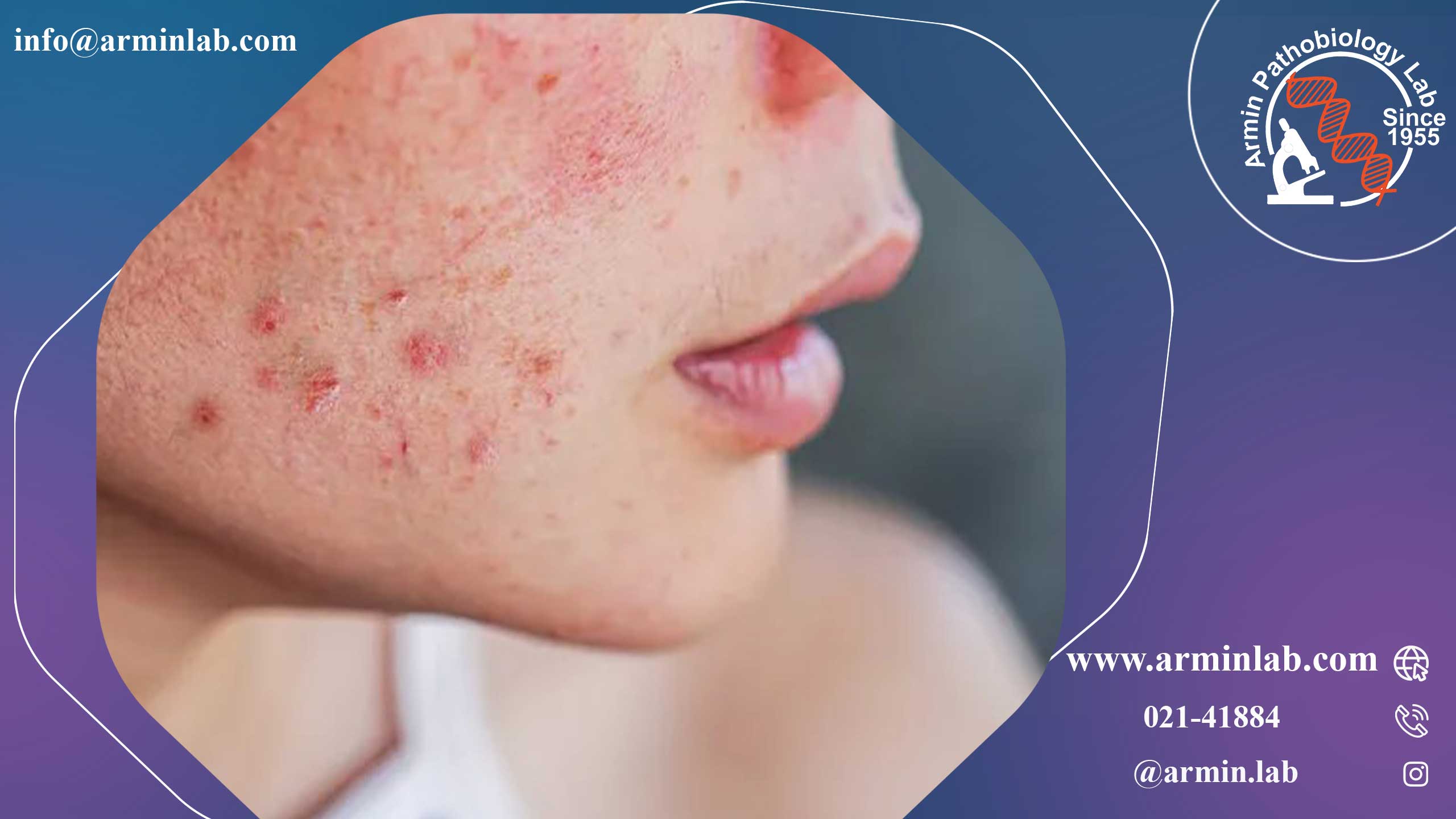 بیماری بهجت یا بیماری جاده ابریشم