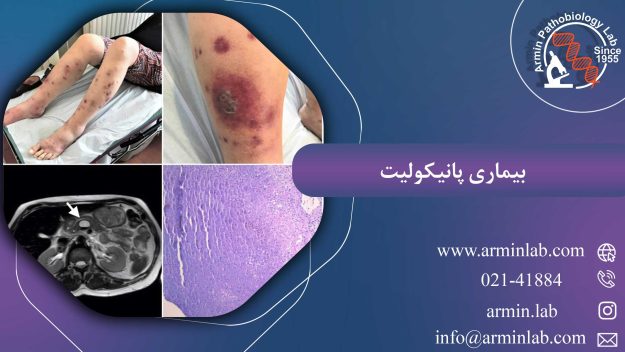 بیماری پانیکولیت