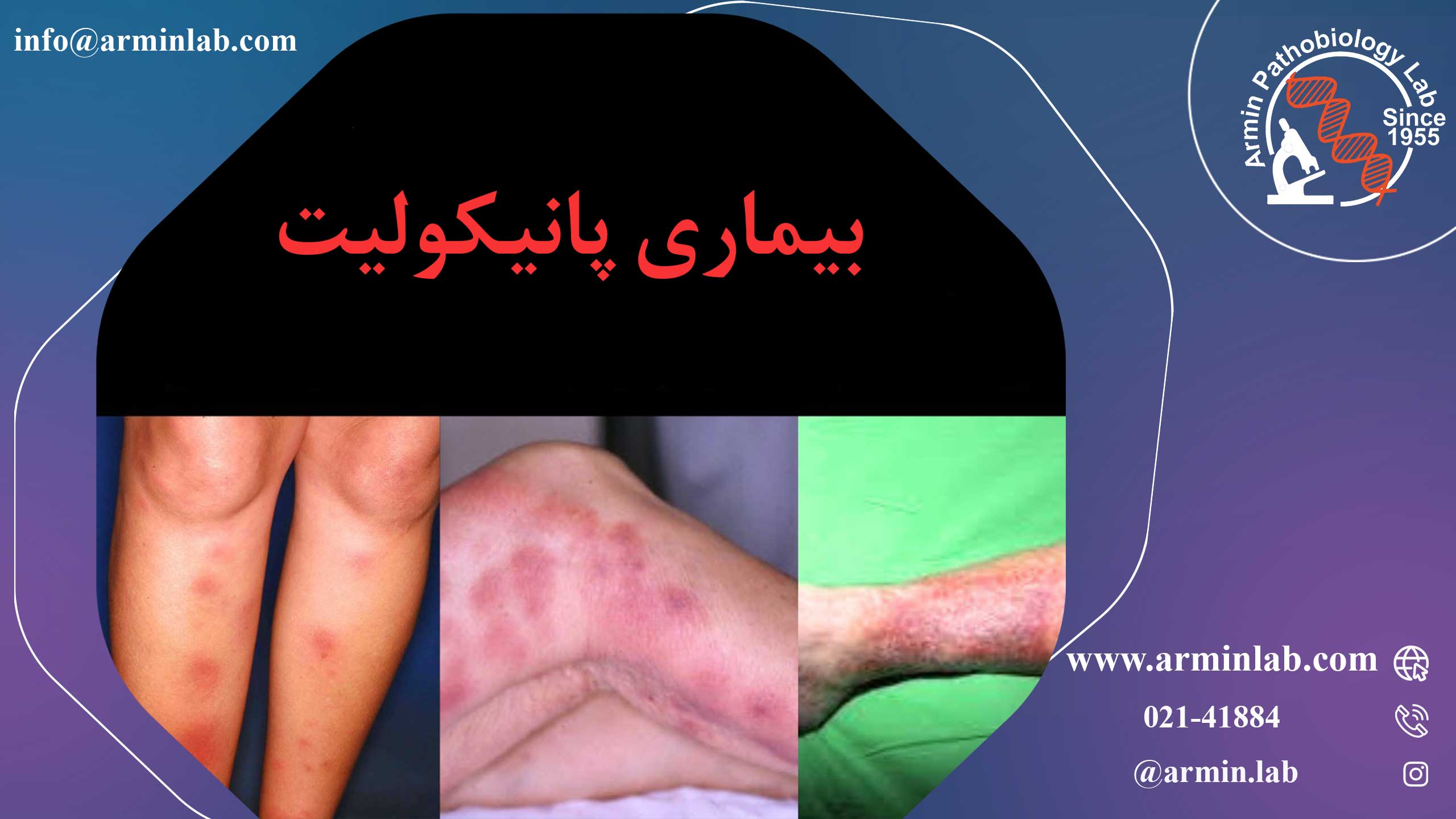 بیماری پانیکولیت 