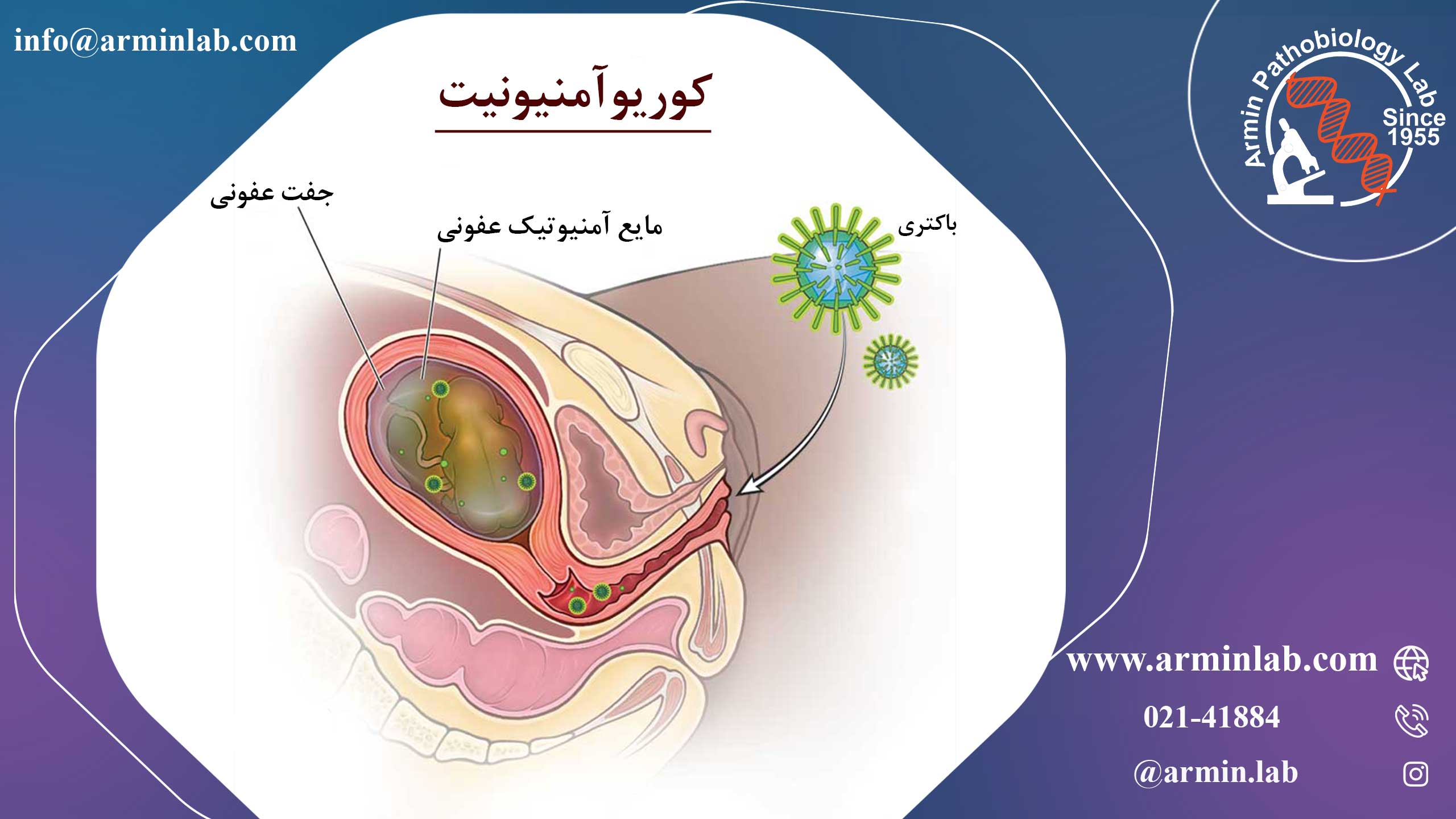 کوریوآمنیونیت یا عفونت آمنیوتیک  