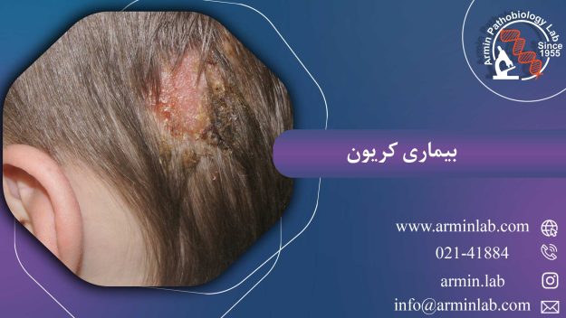 بیماری کریون