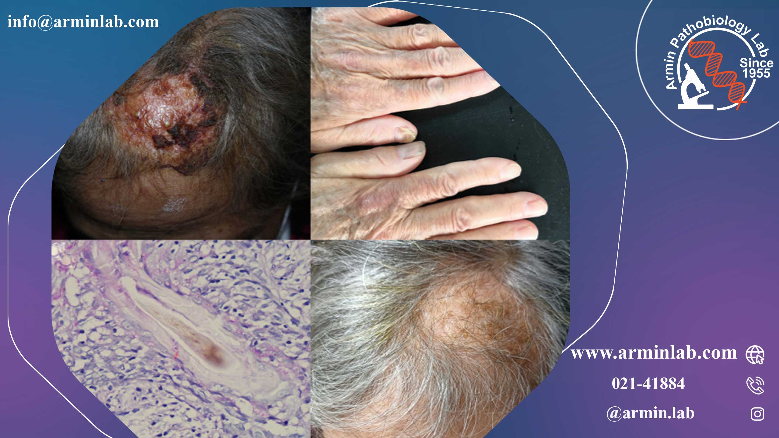 بیماری کریون