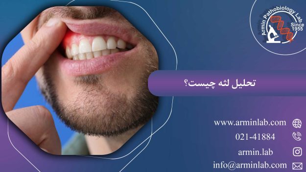 تحلیل لثه چیست؟