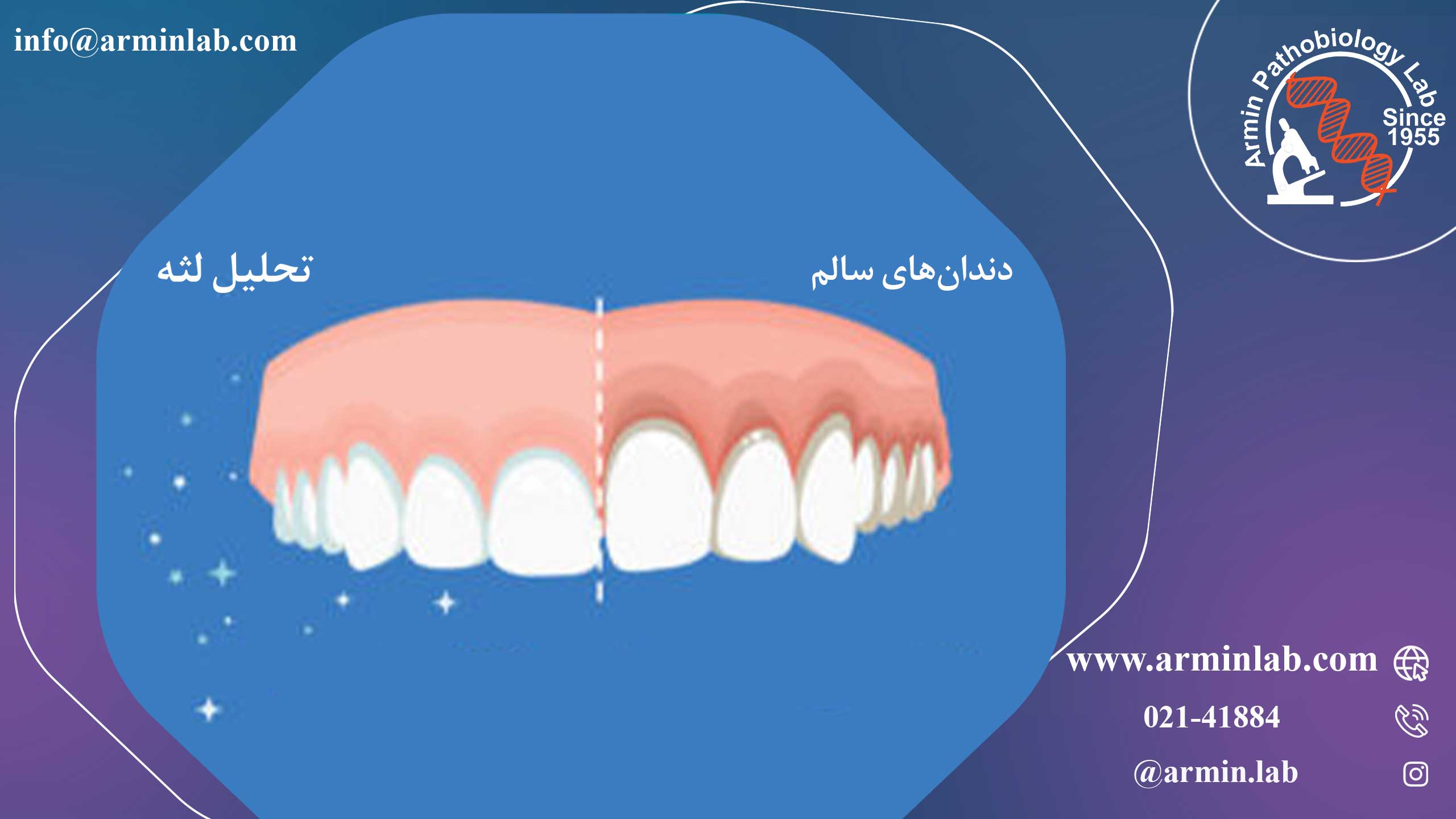 تحلیل لثه چیست؟
