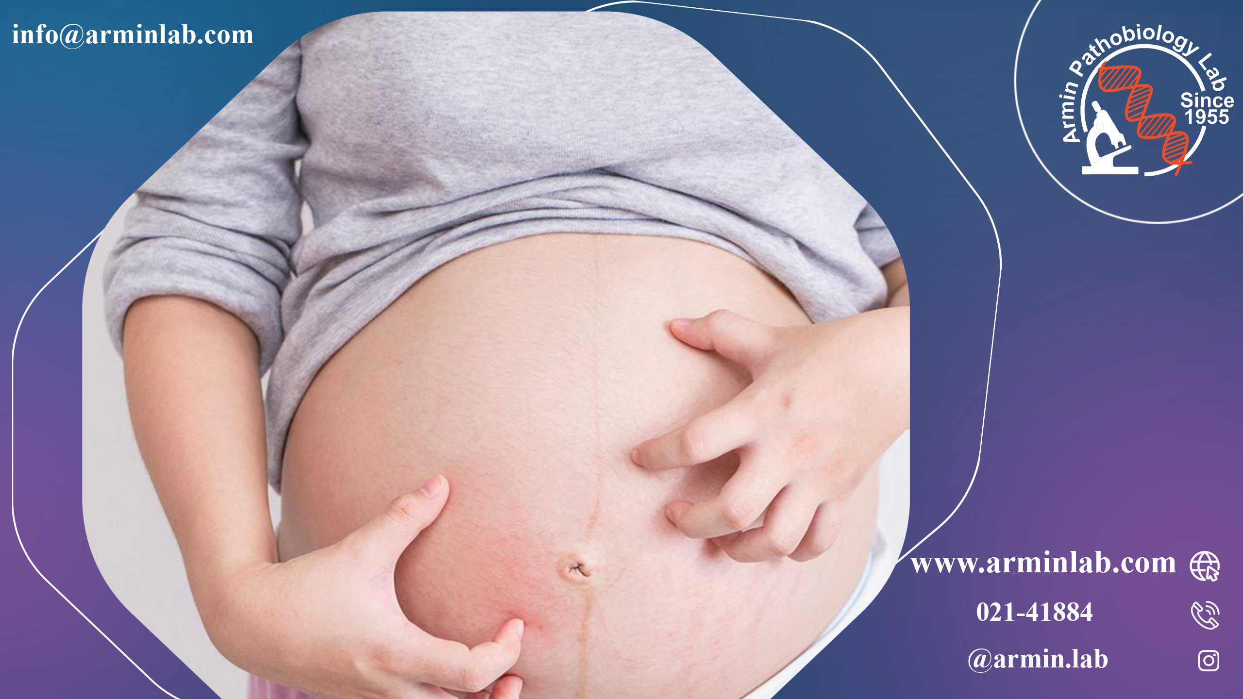 خارش در دوران بارداری