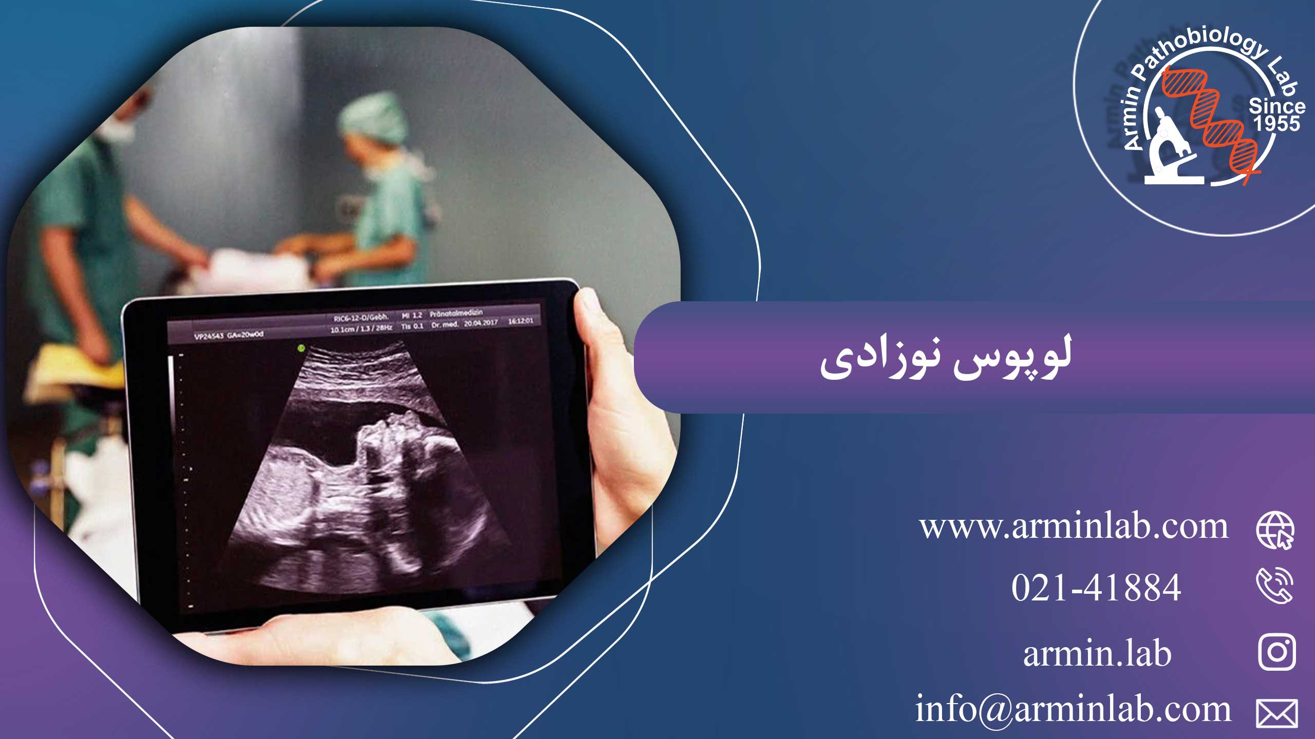 لوپوس نوزادی