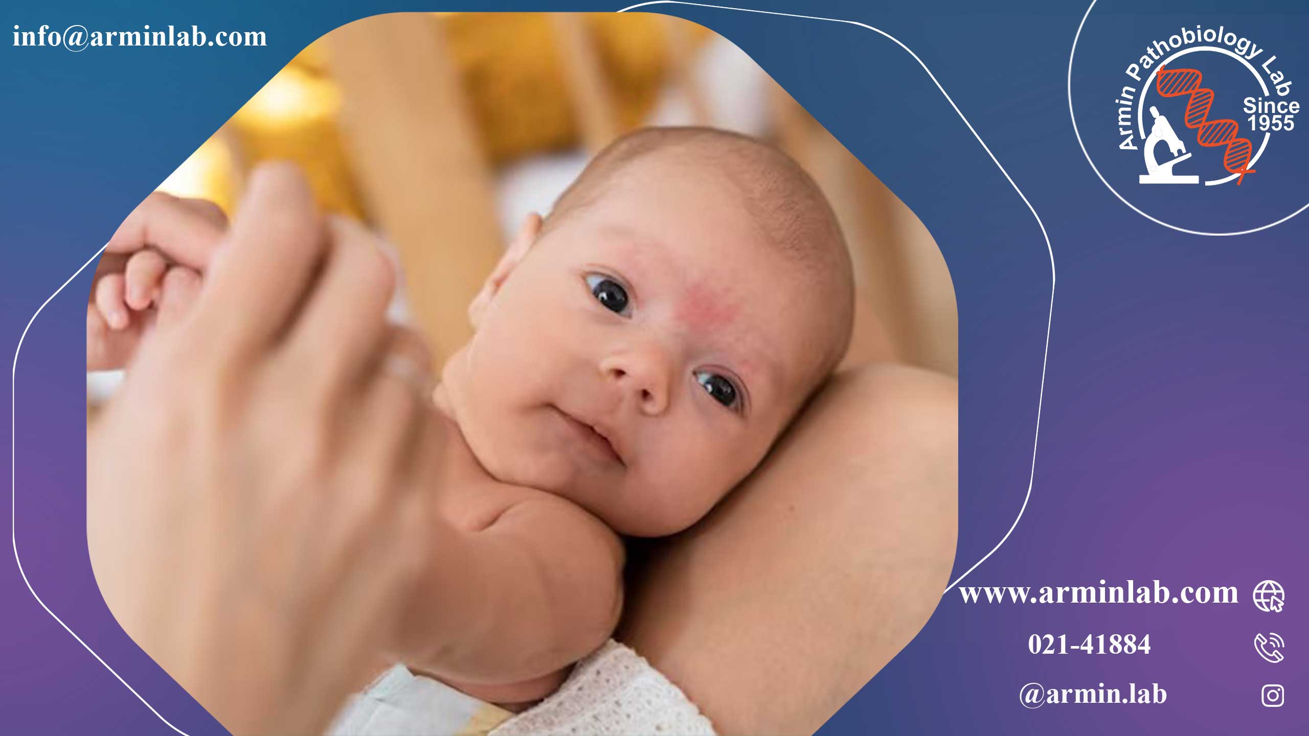 لوپوس نوزادی