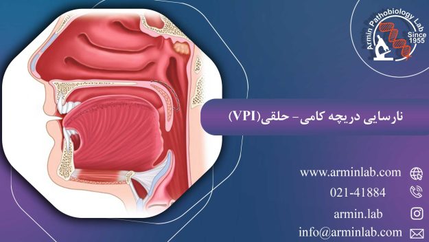 نارسایی دریچه کامی- حلقی(VPI)