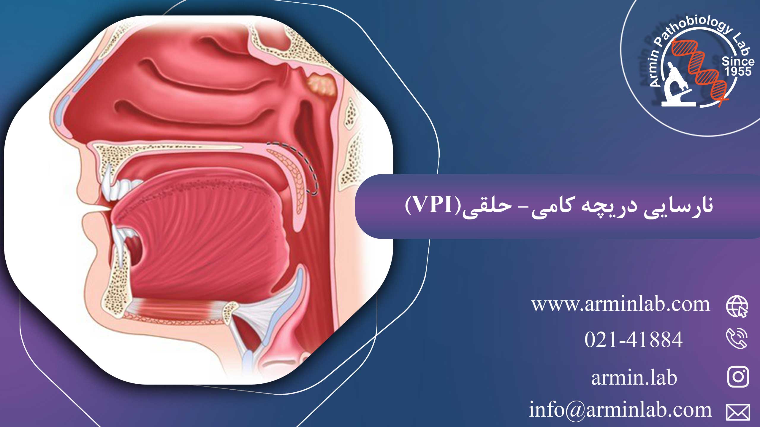 نارسایی دریچه کامی- حلقی(VPI)