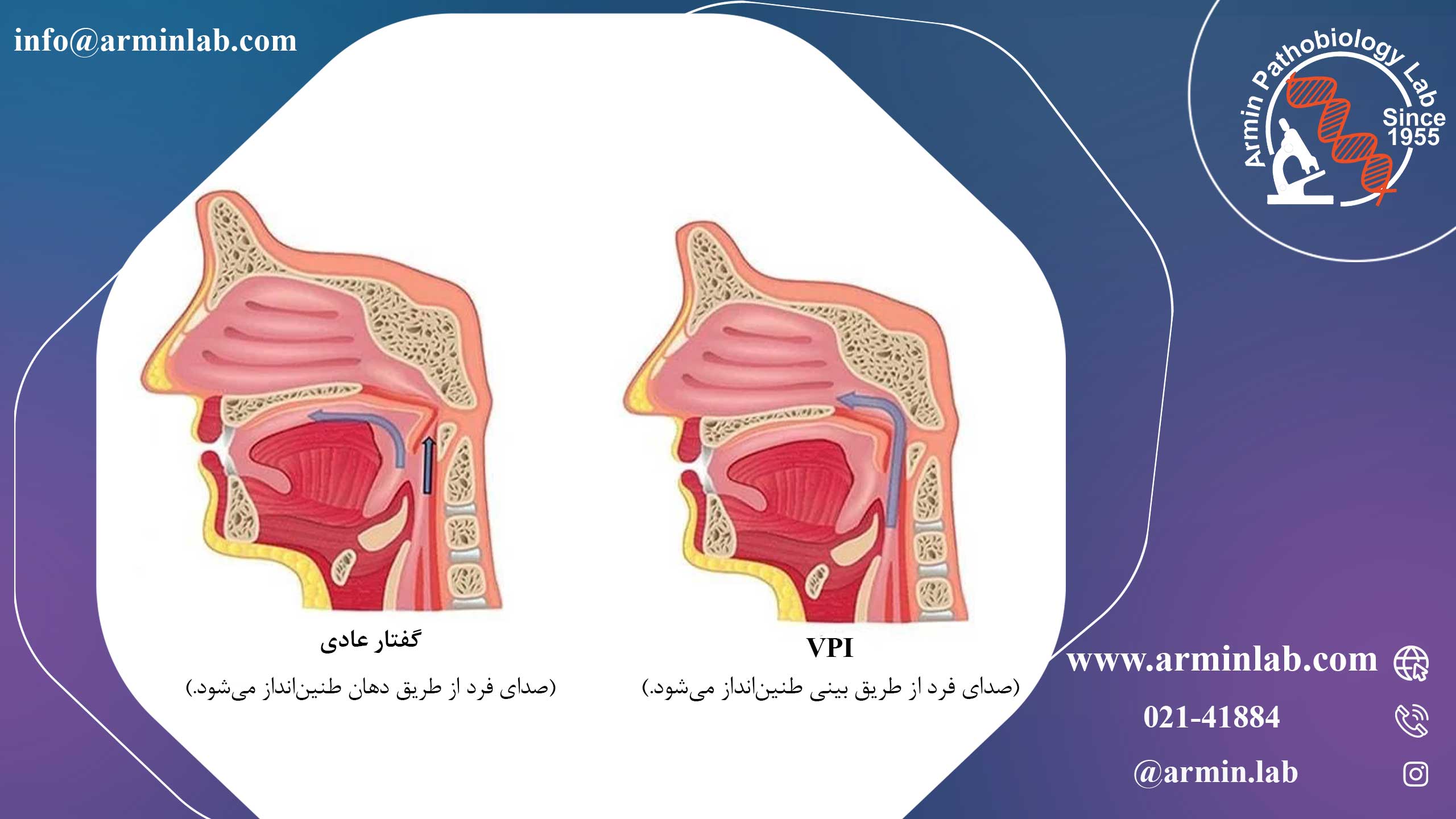 نارسایی دریچه کامی- حلقی(VPI)
