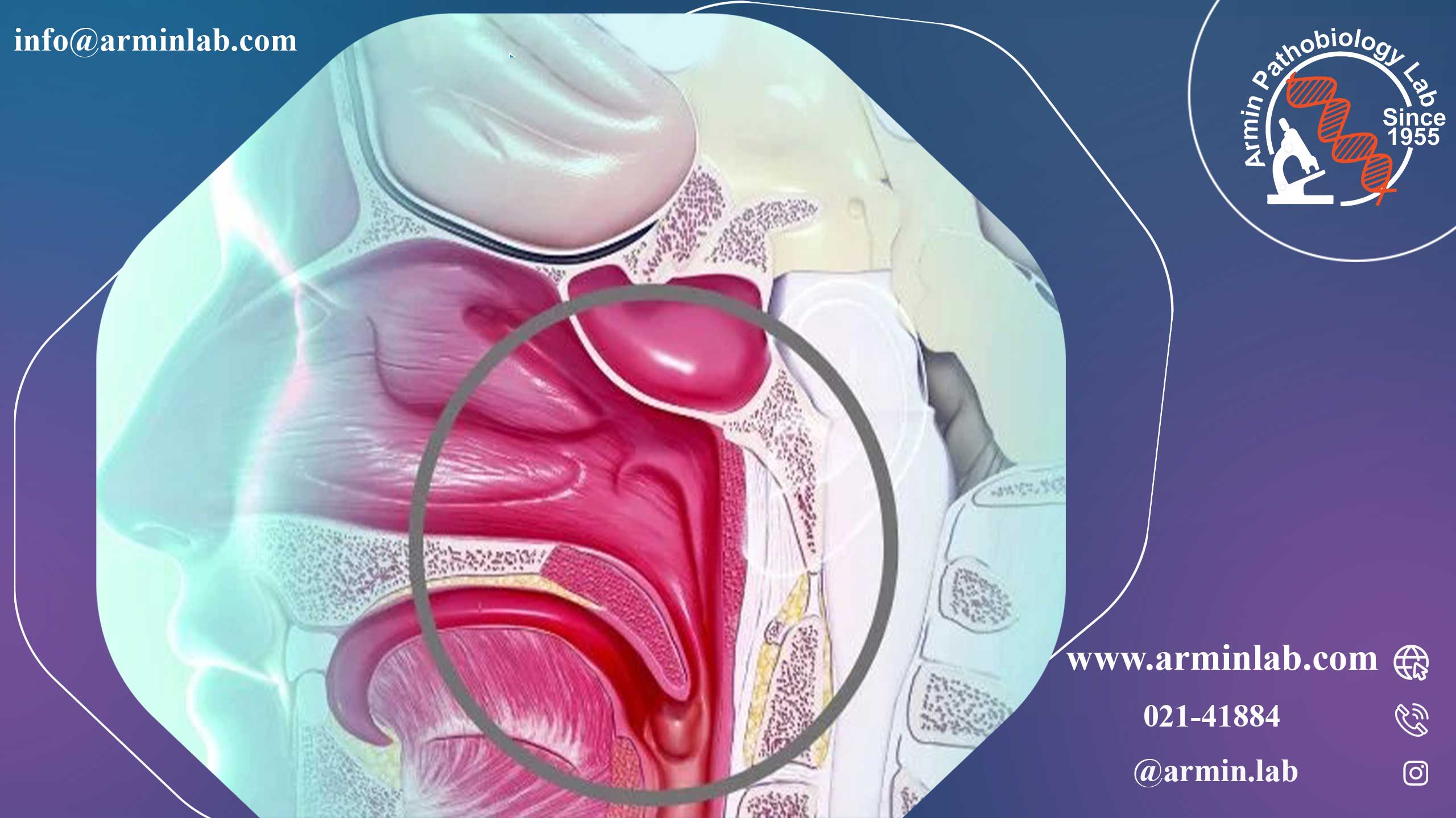 نارسایی دریچه کامی- حلقی(VPI)
