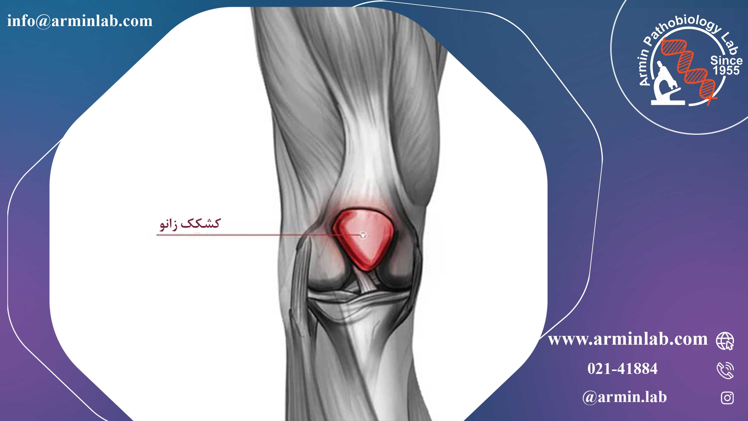 ناپایداری کشکک زانو