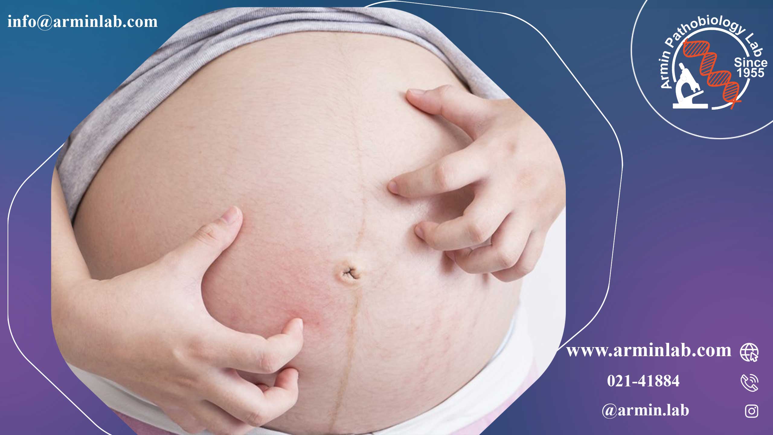 پمفیگوئید بارداری