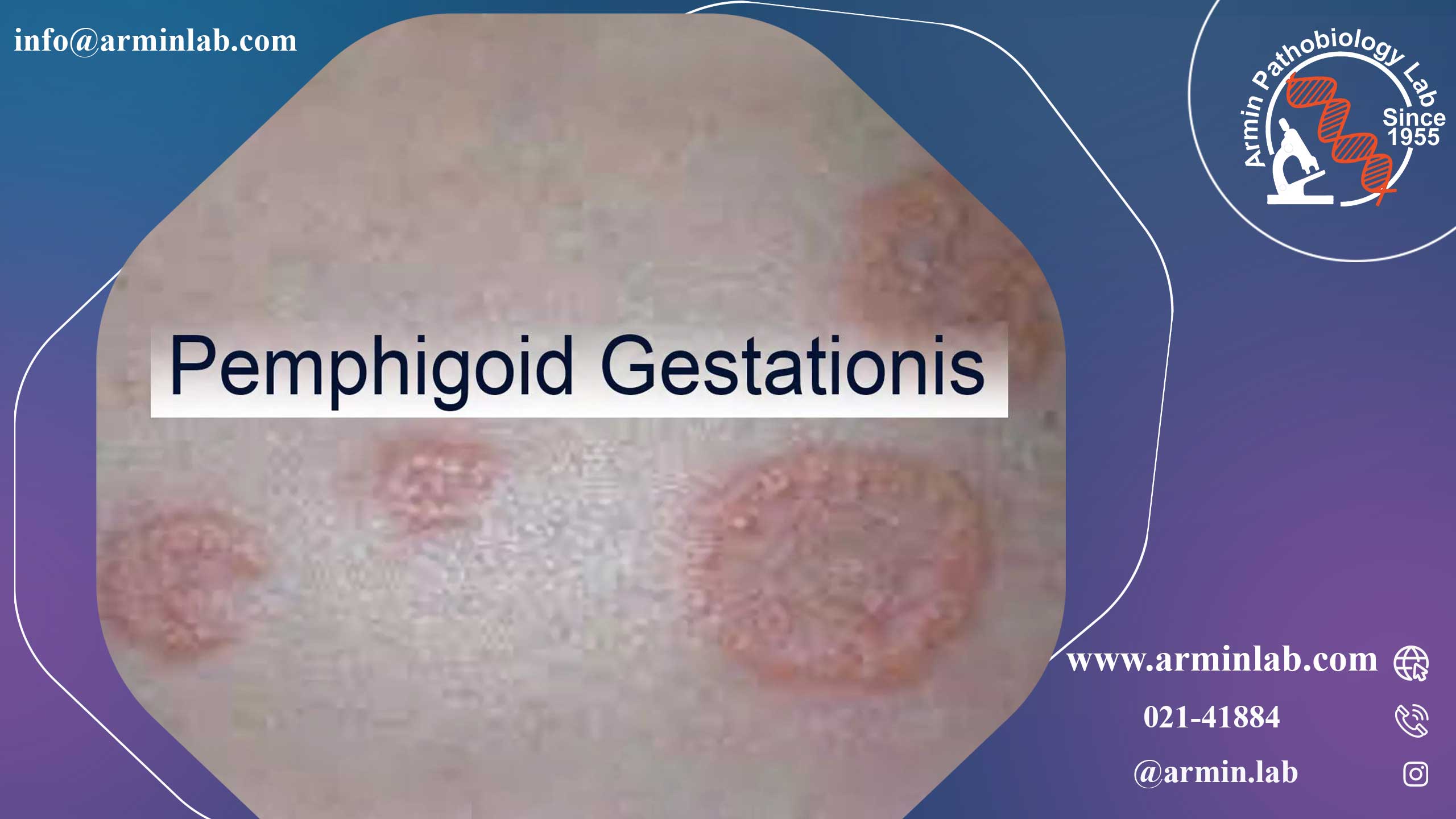 پمفیگوئید بارداری