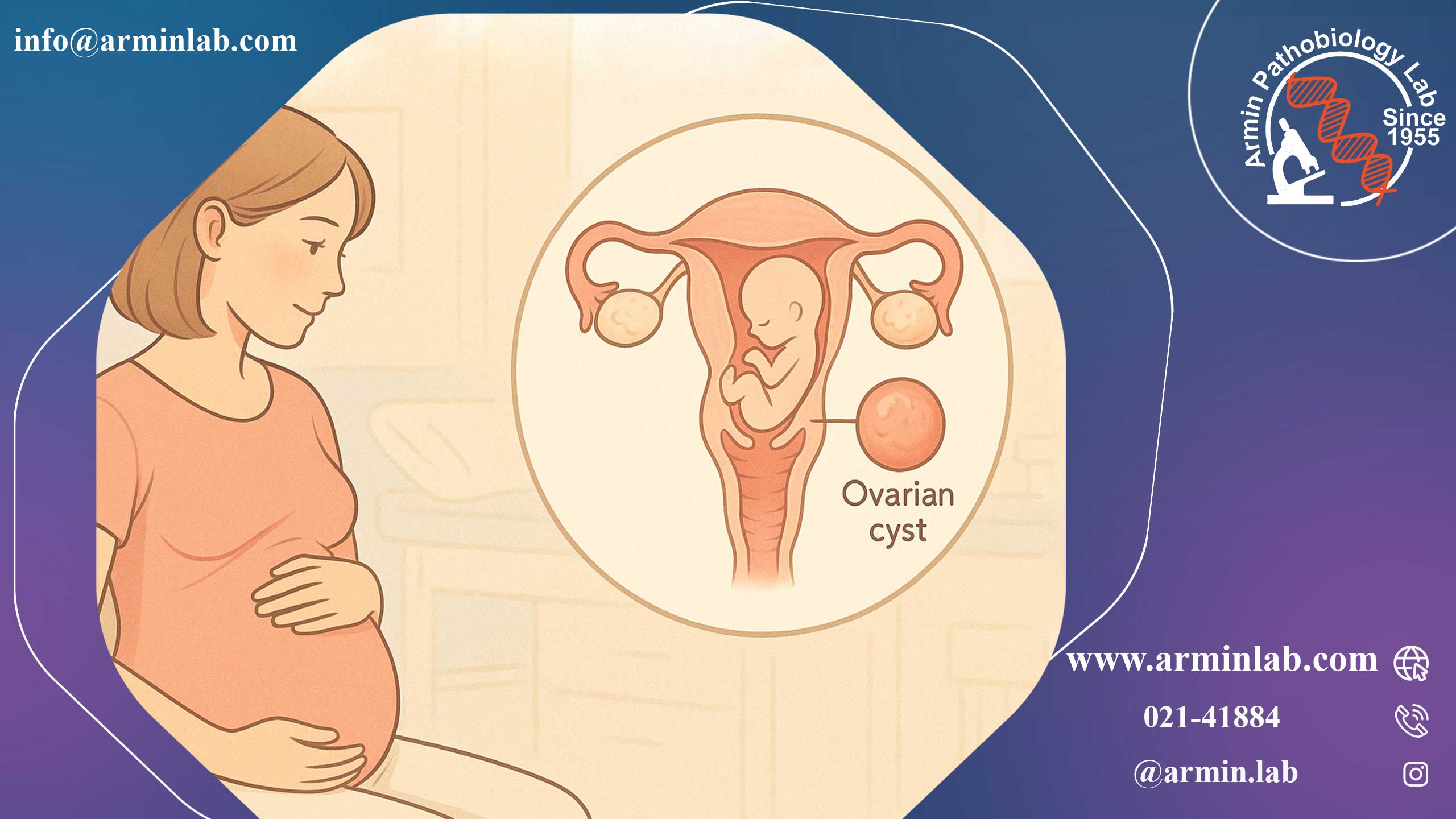 کیست تخمدان در بارداری