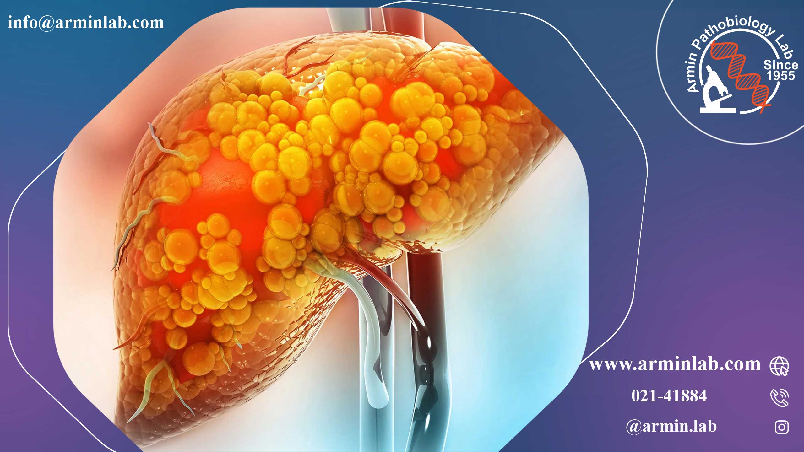 کبد چرب مرتبط با اختلال متابولیک