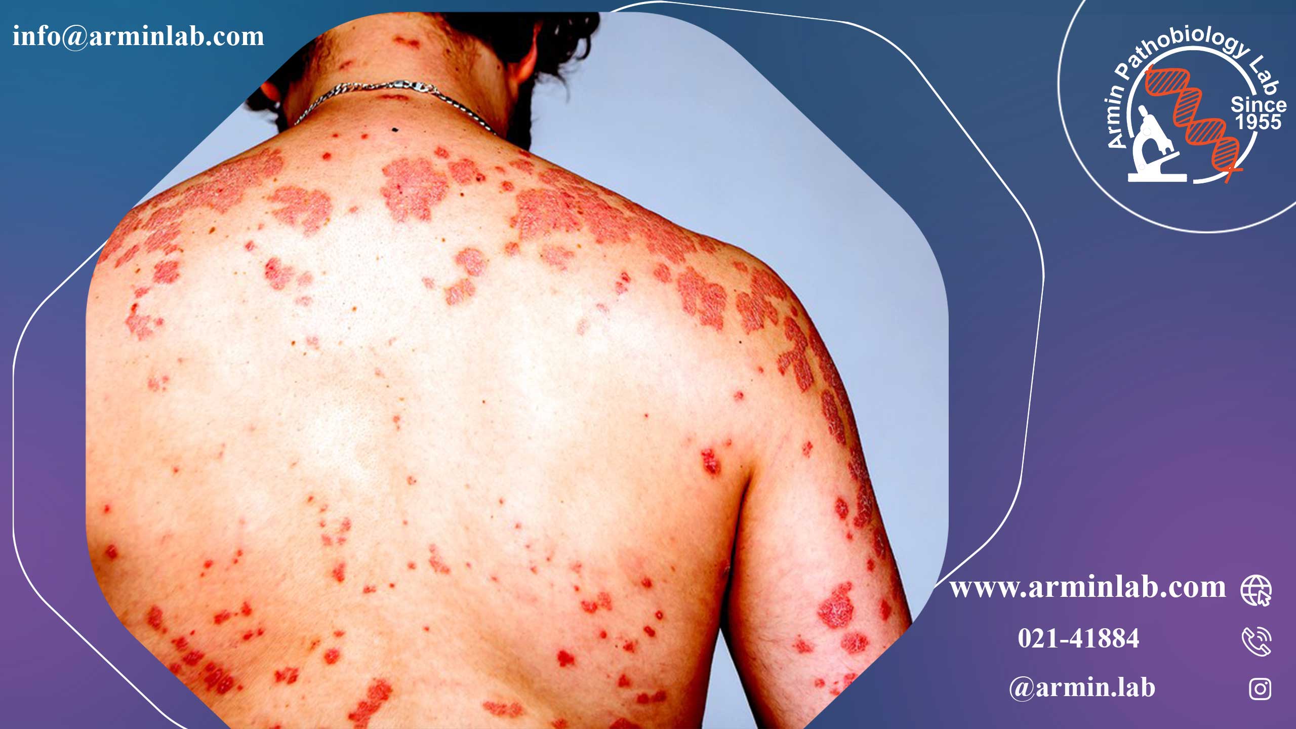 اثرات HIV بر بدن