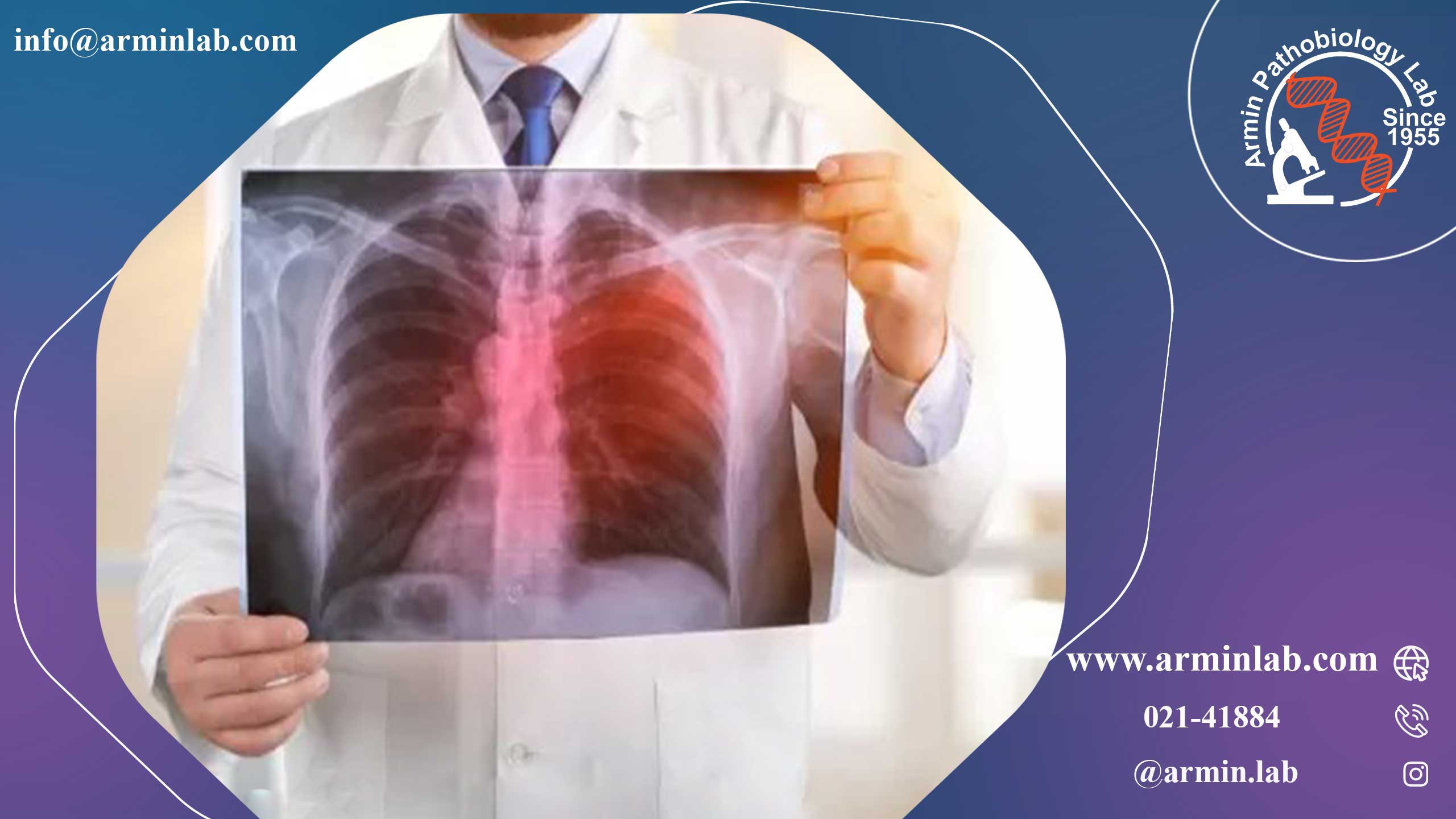 بیماری لژیونر