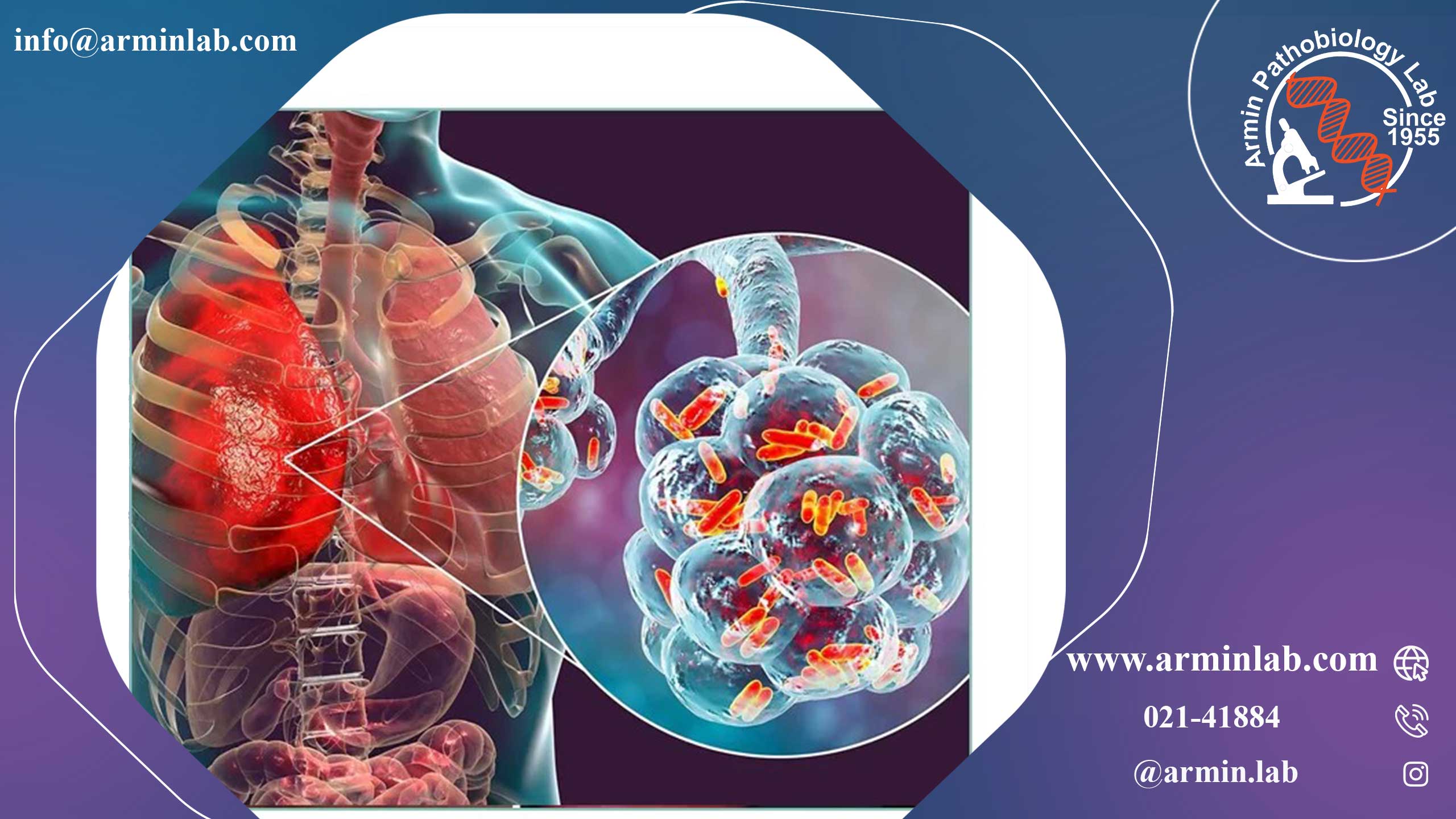 بیماری لژیونر