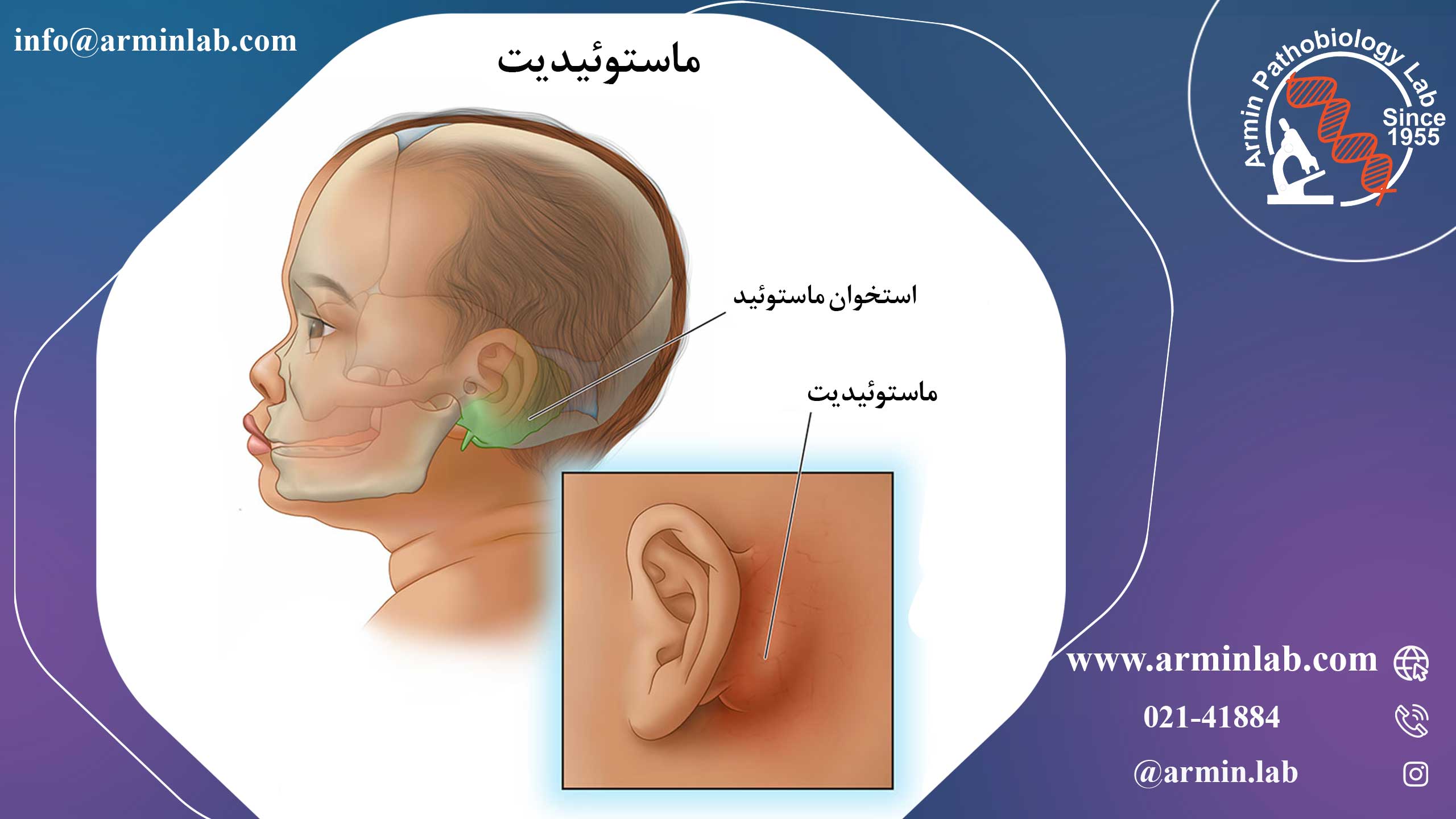 ماستوئیدیت