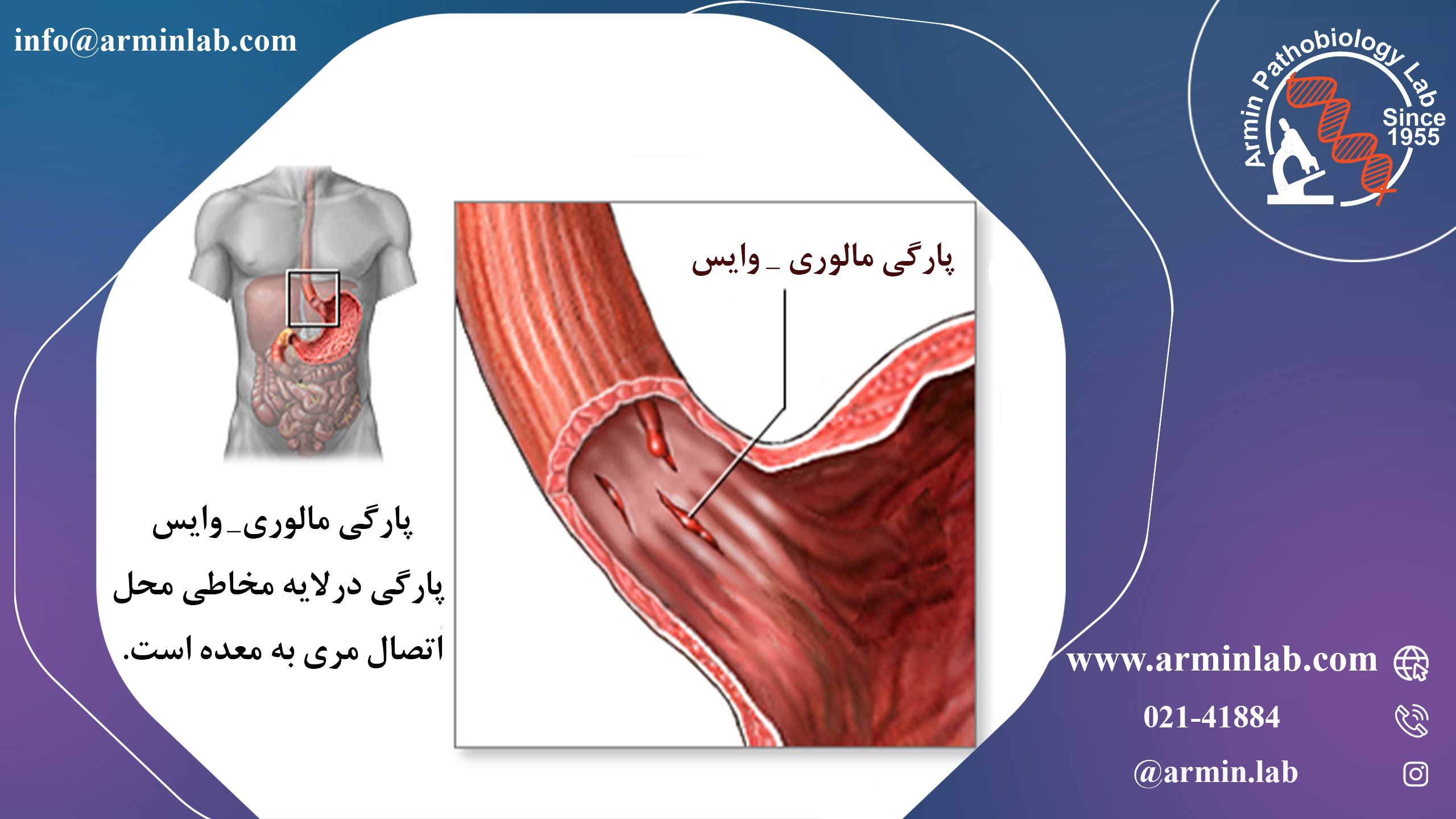 پارگی مالوری_ وایس