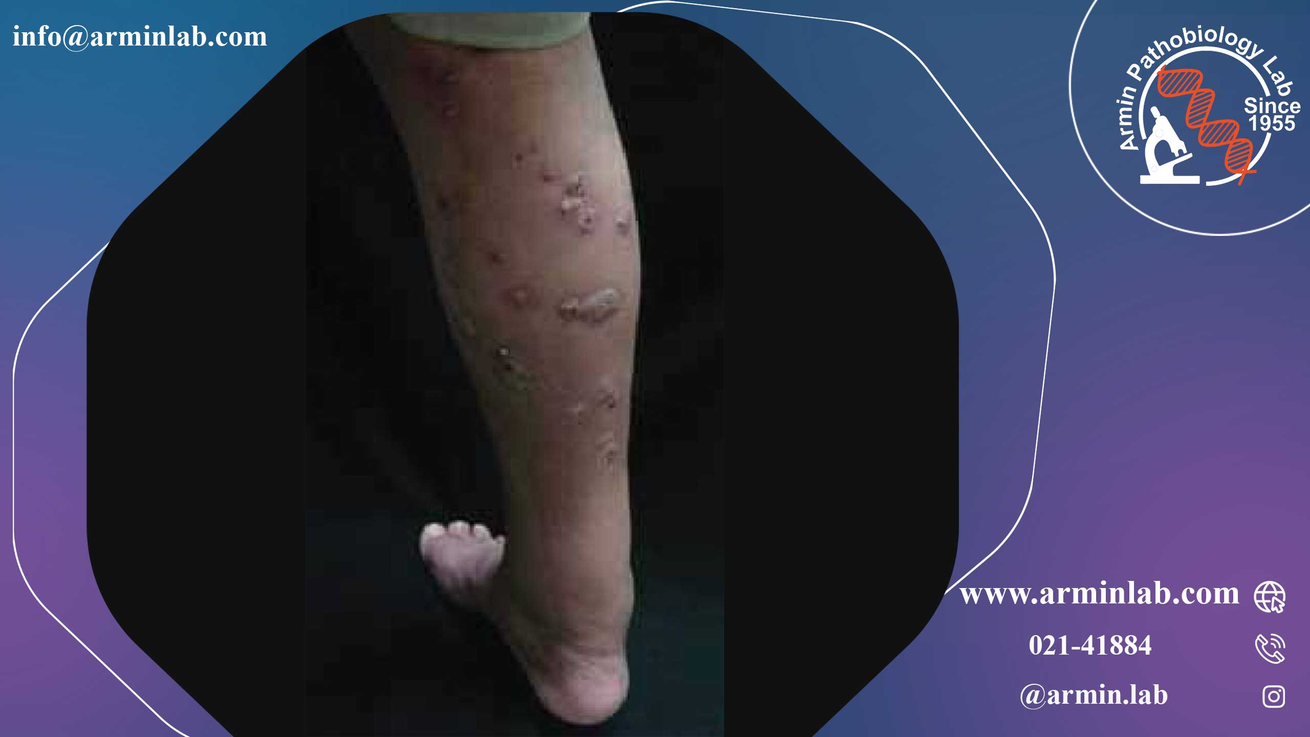 نوکاردیوز چیست؟