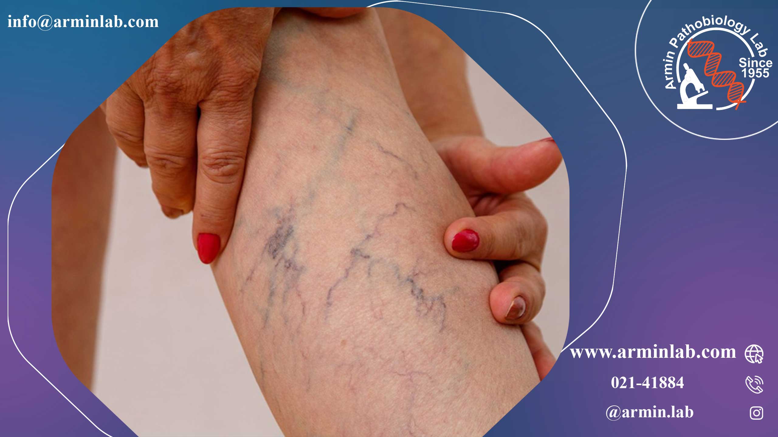 واریس پس از زایمان 