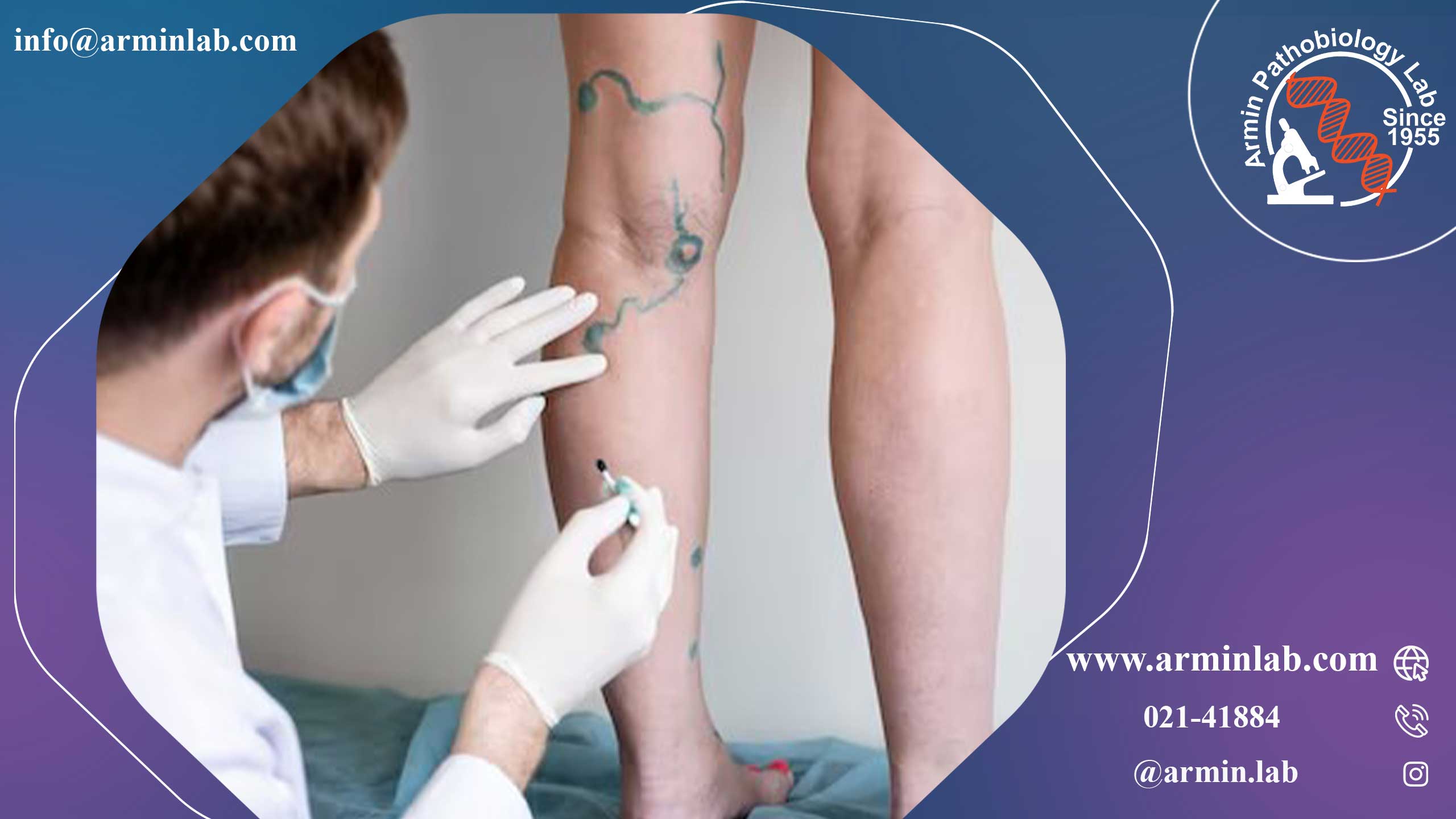 واریس پس از زایمان 