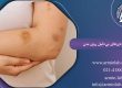 کبودی های بی دلیل روی بدن