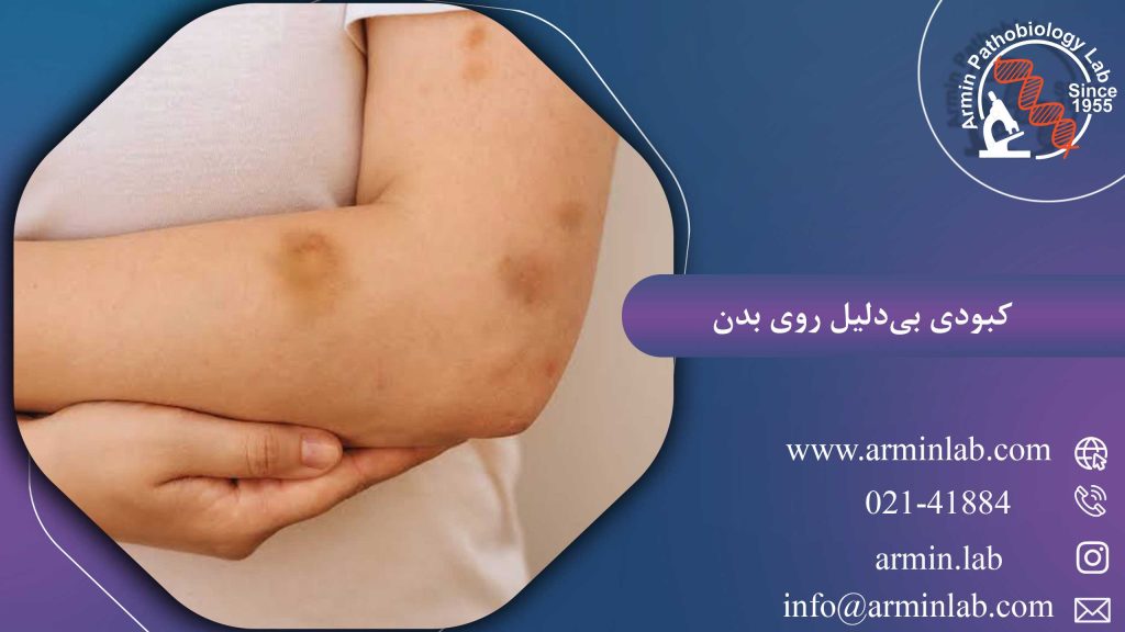 کبودی بی دلیل روی بدن