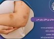 کبودی بی دلیل روی بدن