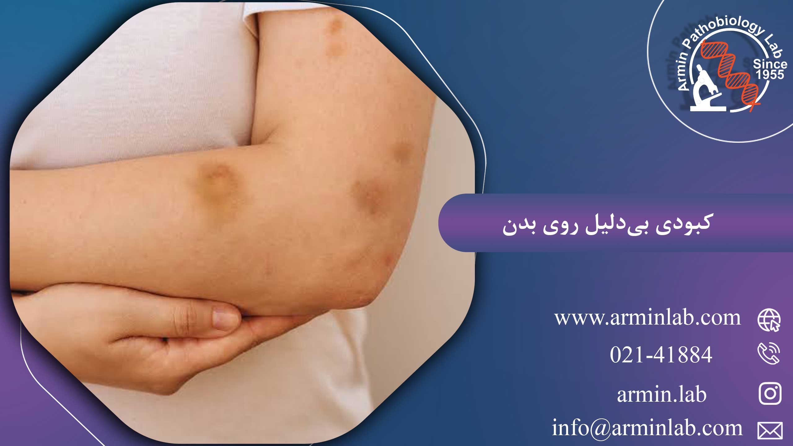 کبودی بی دلیل روی بدن