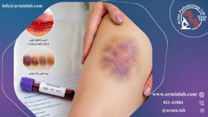 کبودی های بی دلیل 