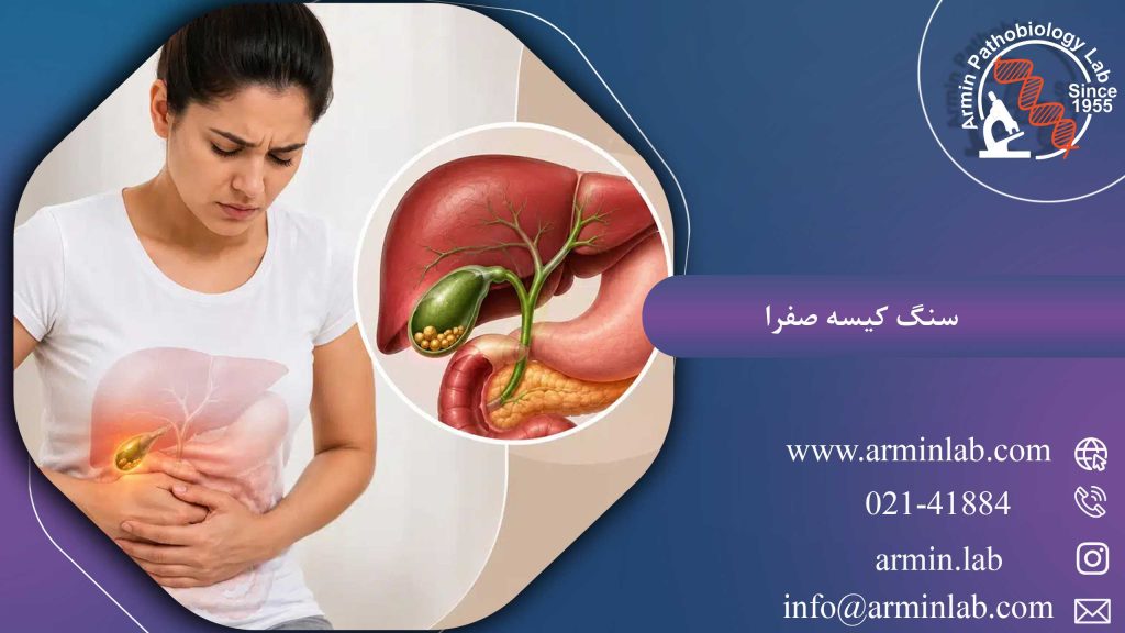 سنگ کیسه صفرا